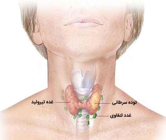 سرطان تیروئید قابل درمان است ؟ ندول تیروئید- متخصص غدد